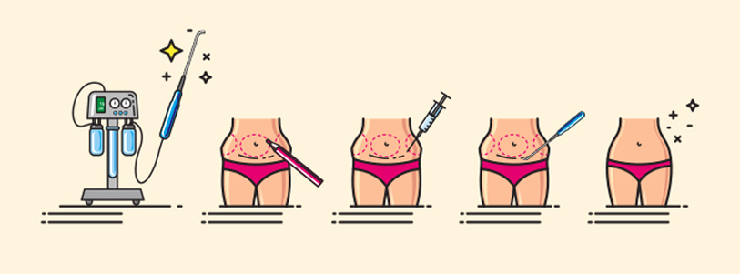 Decoding Liposuction Surgery Cost in Noida