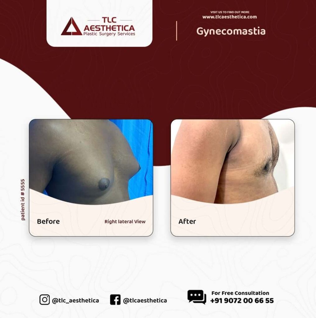 Which drugs Can Cause Gynecomastia in Men