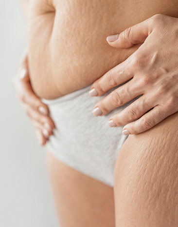 Stretch mark reduction
