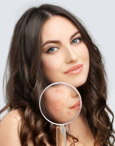 Post acne scars