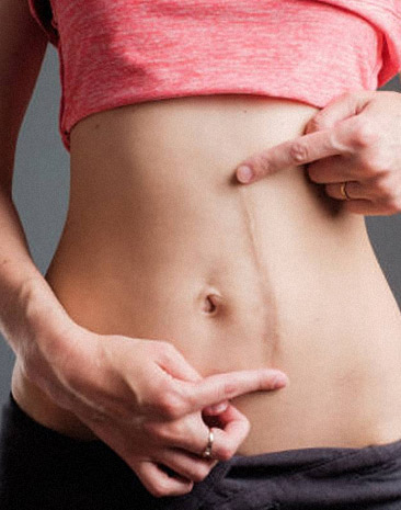 Scar reduction